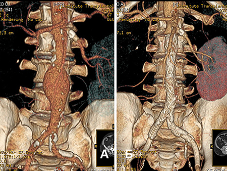аневризма аорти