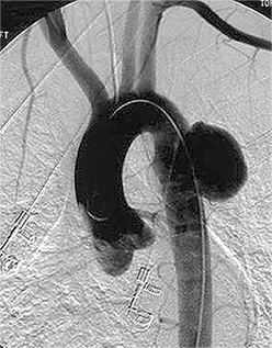 мішотчата аневризма аорти