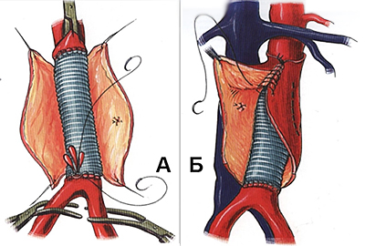 аневризма аорти