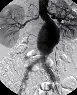 веретеноподібна аневризма аорти