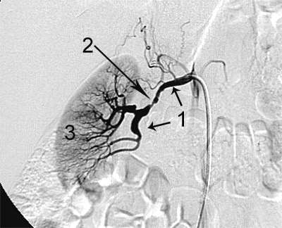 стеноз правої ниркової артерії