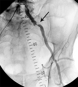 стеноз лівої клубової артерії