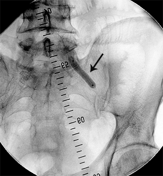 балон, роздутий в зоні стенозу