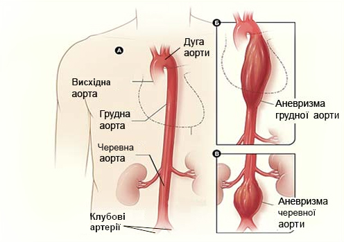 аневризма аорти