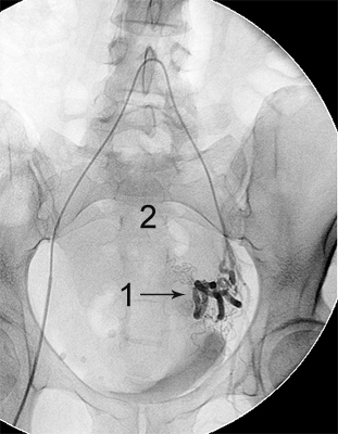 міома матки після емболізації