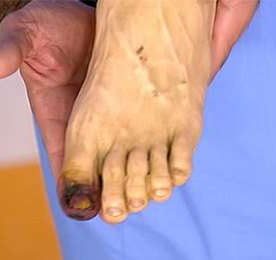 гангрена стопи