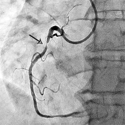 стеноз правої коронарної артерії