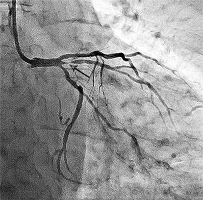 стеноз лівої коронарної артерії