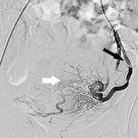 міома матки після емболізації