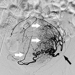 міома матки до емболізації