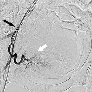 міома матки після емболізації