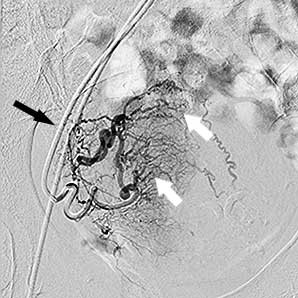 міома матки до емболізації