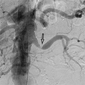 стеноз лівої ниркової артерії