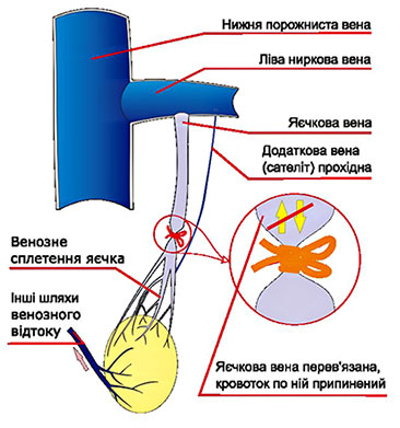 операція Іваніссевича