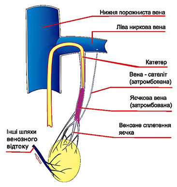 емболізація яєчкової вени
