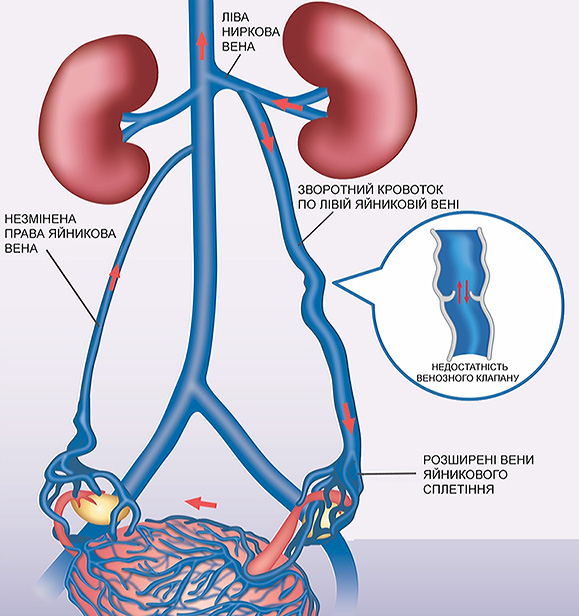стентування