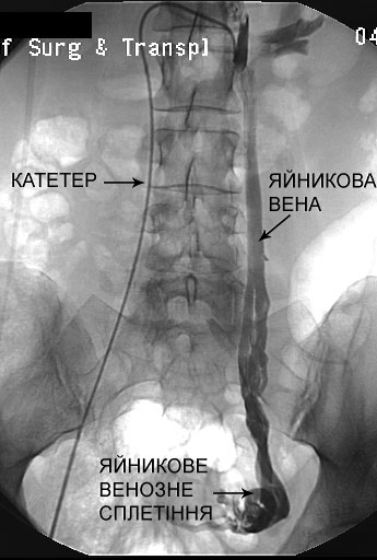стентування